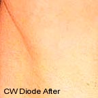 Laser hair removal underarm after picture