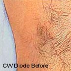 Laser hair removal underarm before picture