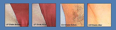 lazer hair removal before and after pictures