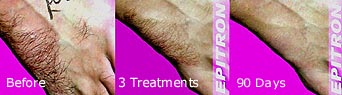 body hair before and after treatment