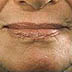 Lazer collagen stimulation facial area after