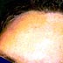 facial hairline contouring picture after
