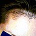 facial hairline contouring picture before