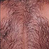 IPL Hair Removal Back