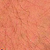 IPL Tattoo Removal After