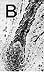 Follicle after transdermal electrolysis