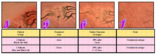 Eliminación de tatuajes IPL antes y después