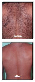 IPL Hair Removal Before and After, Male Back