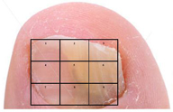 Procedimiento de tratamiento IPL de hongos en las uñas