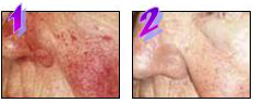 Rosácea en la nariz antes y después de los tratamientos con IPL