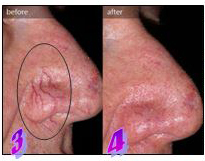 Veines d'araignée sur le nez avant et après les traitements IPL