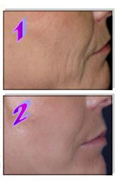 Procedimiento de tratamiento IPL: rejuvenecimiento y reducción de arrugas