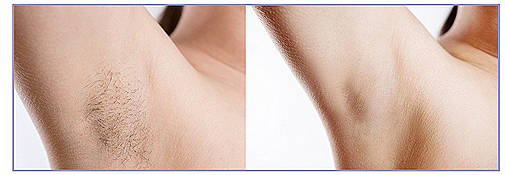 laser hair removal before and after photos