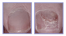Laser Nail Fungus Treatment Before and After Photos